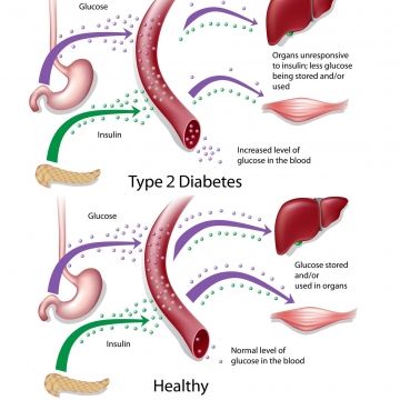 Tinh bột kháng và bệnh tiểu đường type 2